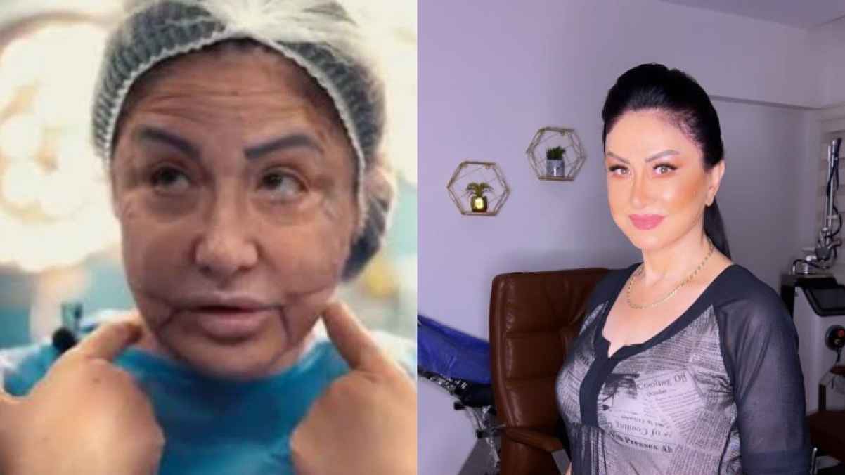 فنانة مصرية تروي تفاصيل تعرضها للابتزاز بعد تشوه وجهها بسبب التجميل