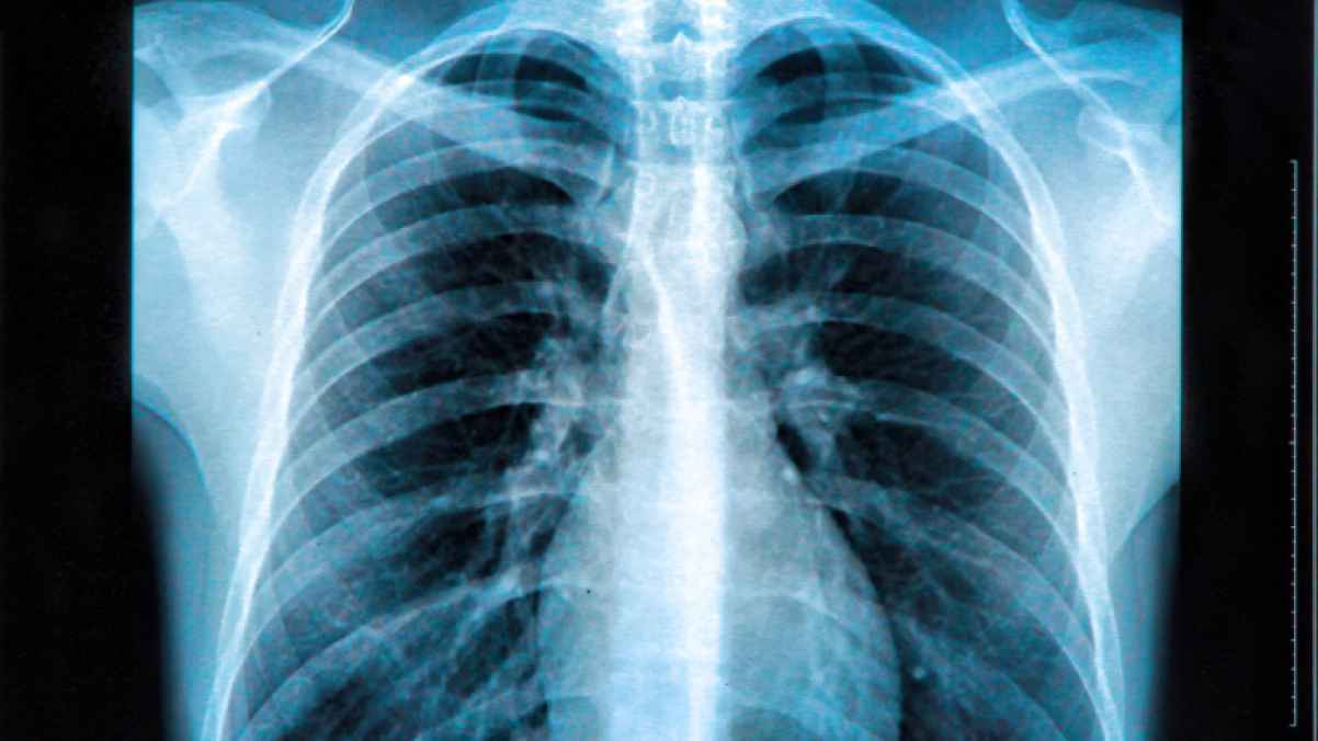 Woman agrees to collude with boyfriend against insurance after bone injury