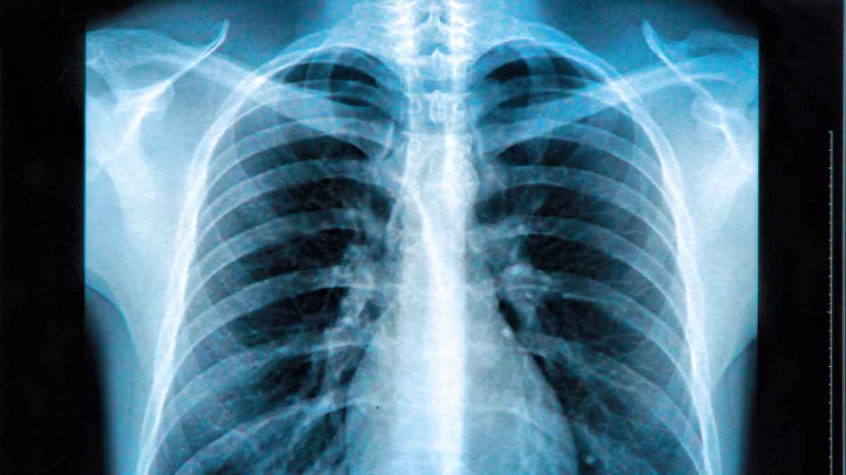 Woman agrees to collude with boyfriend against insurance after bone injury