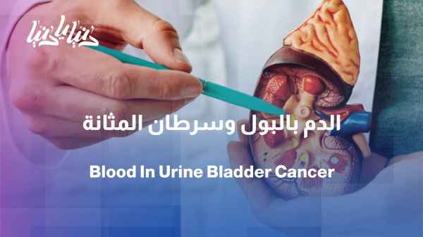 Blood in the urine... When is it a warning sign of bladder cancer?