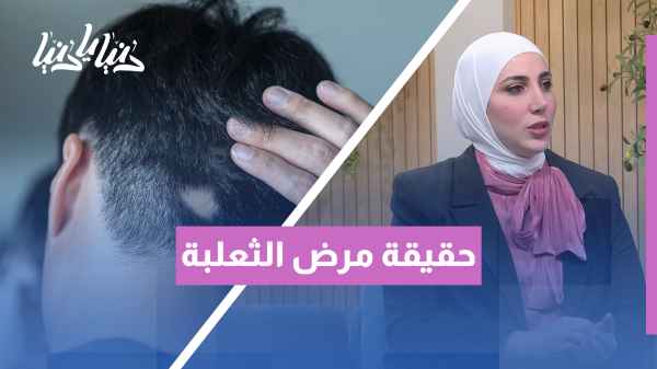 Is alopecia inherited through genes? And what is its relationship to hair loss?