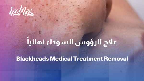 Why do blackheads appear? And what is the correct way to get rid of them?